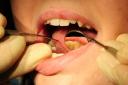 The number of people waiting for NHS dental treatment in Powys has now exceeded 5,000, according to figures provided by Powys Teaching Health Board this week. (Image: PA).