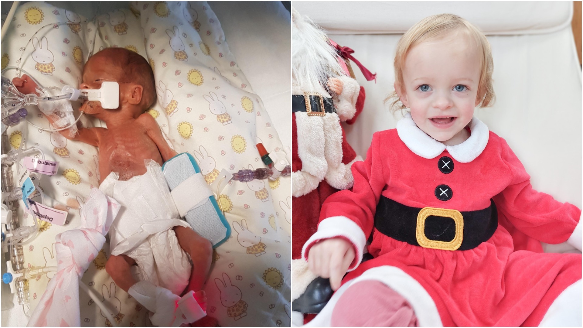 Left: Ayda Evans in a neonatal intensive care unit in hospital. Right: One-year-old Ayda celebrating Christmas in December 2021. Pictures by Tanya Evans